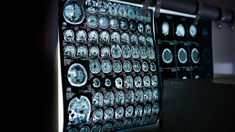 Rezonans magnetyczny głowy – klucz do skutecznej diagnostyki